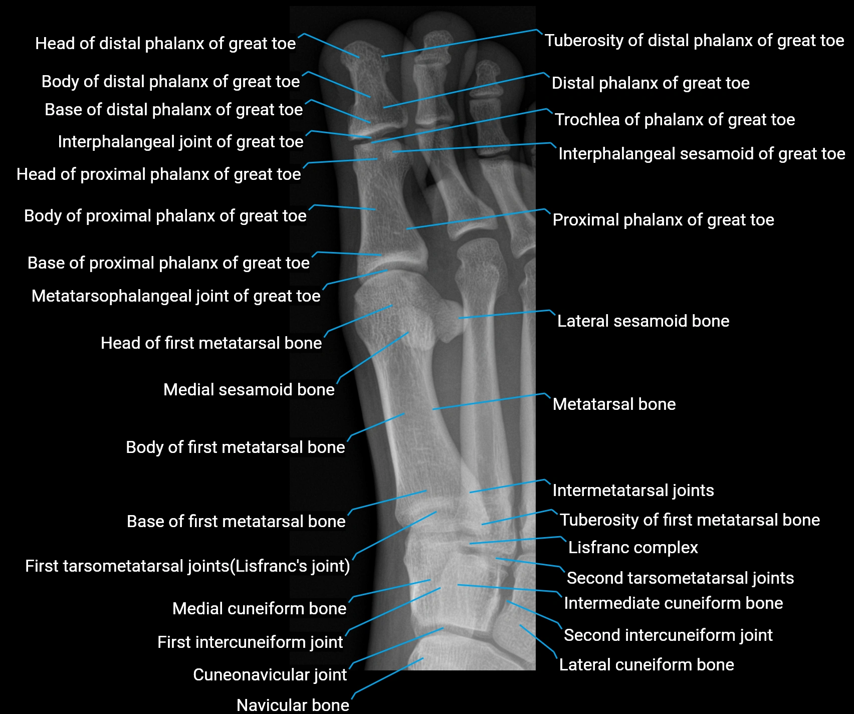 X Ray great toe obl anatomy labelled.webp